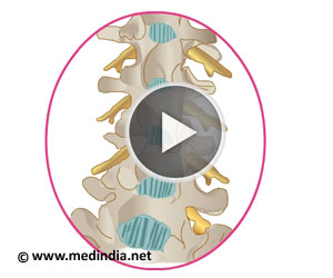 脊髓或硬膜外麻醉