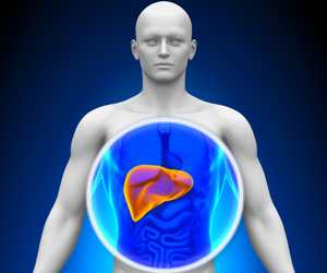 低剂量对乙酰氨基酚与减少严重肝损伤有关