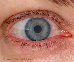 干眼病可改变角膜损伤后的愈合