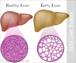 脂肪肝:印度日益严重的健康问题