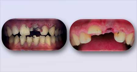 牙外伤的故事——牙外伤指南和管理