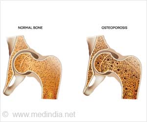骨质疏松症药物可能降低2型糖尿病的风险