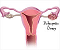 关于多囊卵巢综合征的12大事实
