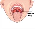 口咽癌